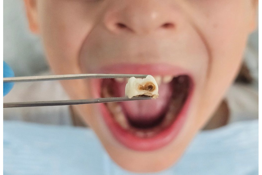 Caries dental en niños