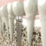 Implantología dental en Mataró