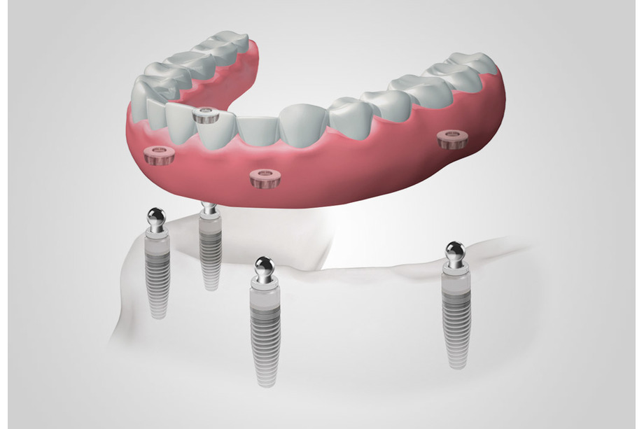 Dentadura extraíble con implantes en Mataró