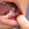 Urgencias dentales en Mataró