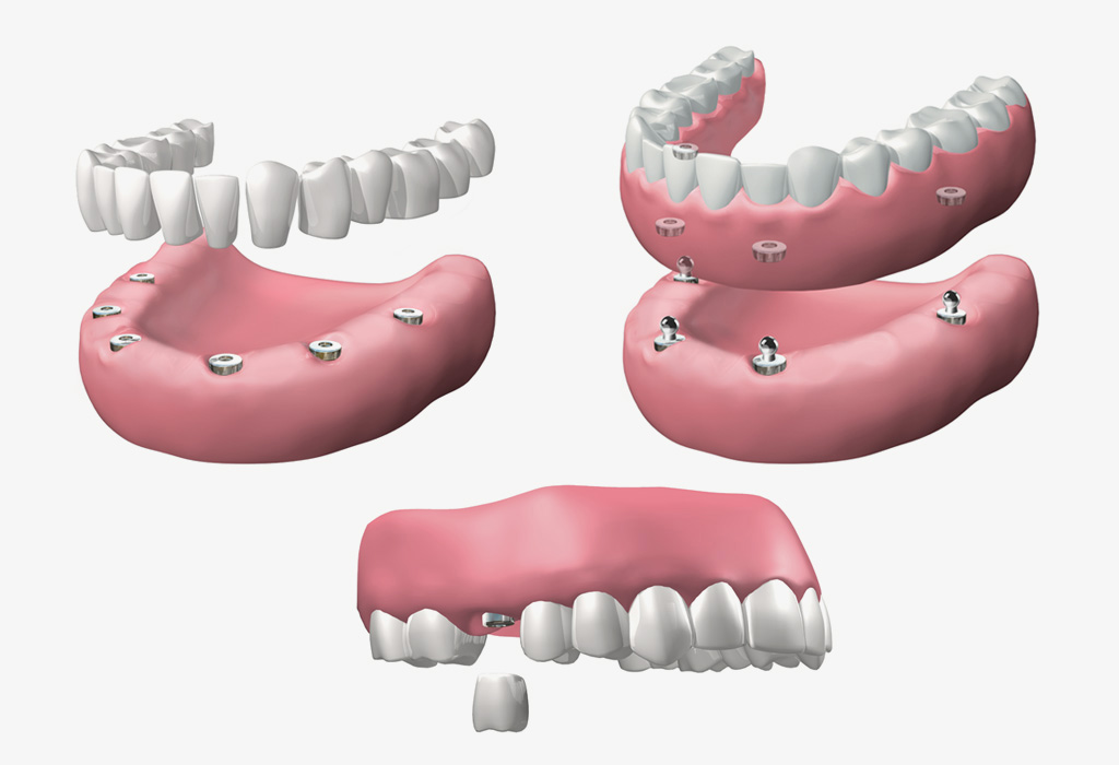 Implantes dentales Mataró