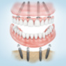 implantes dentales en Mataró