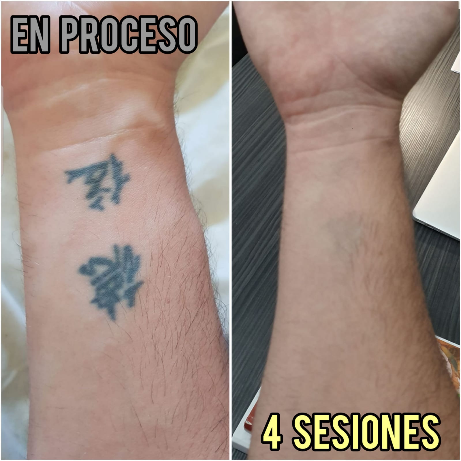 foso Intacto Ciencias Lasser Tattoo Valencia - Noticias Eliminacion laser de Tatuajes