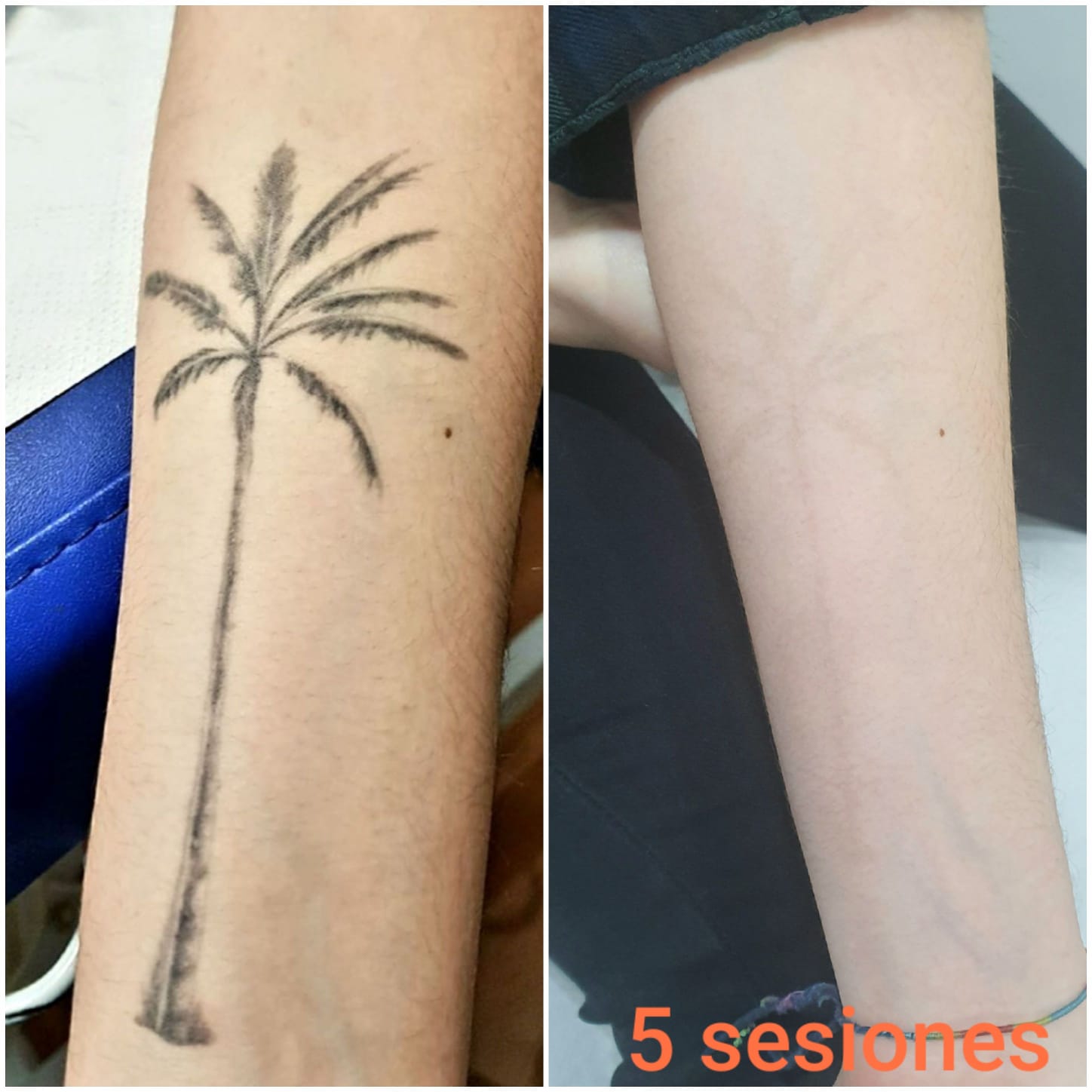 Lasser Tattoo Valencia - Noticias Eliminacion laser de Tatuajes