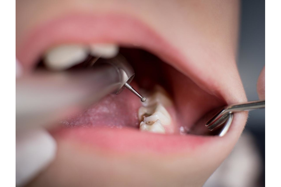 clinica caries aluche