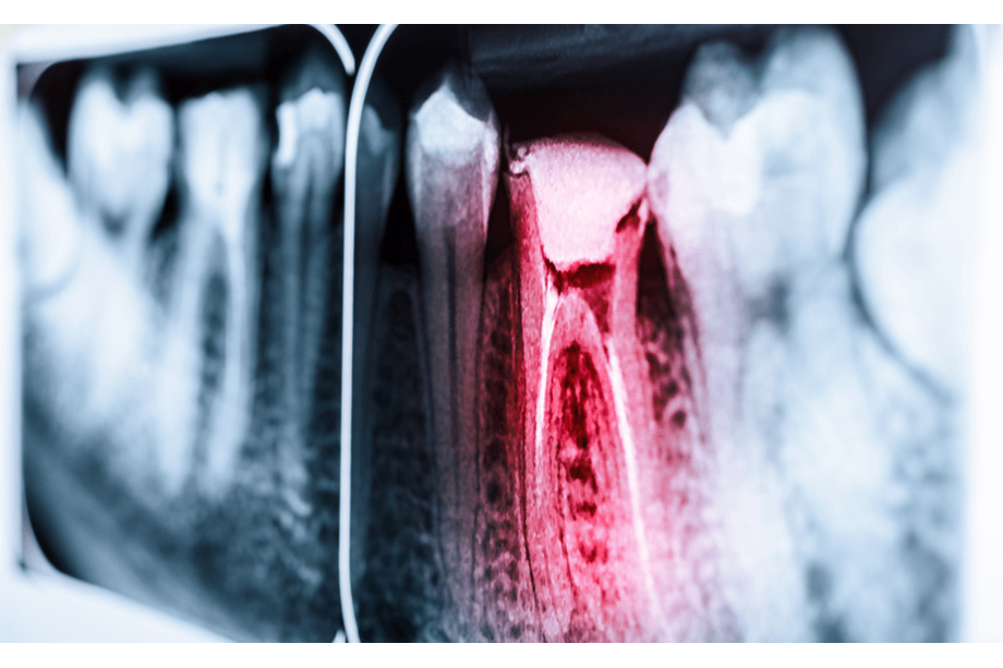 endodoncia en aluche
