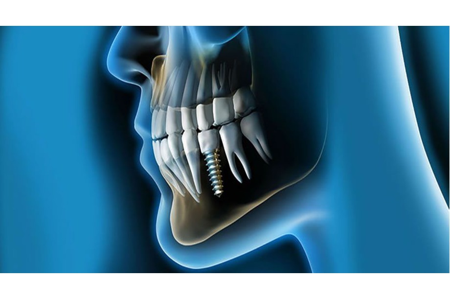 implantes dentales aluche