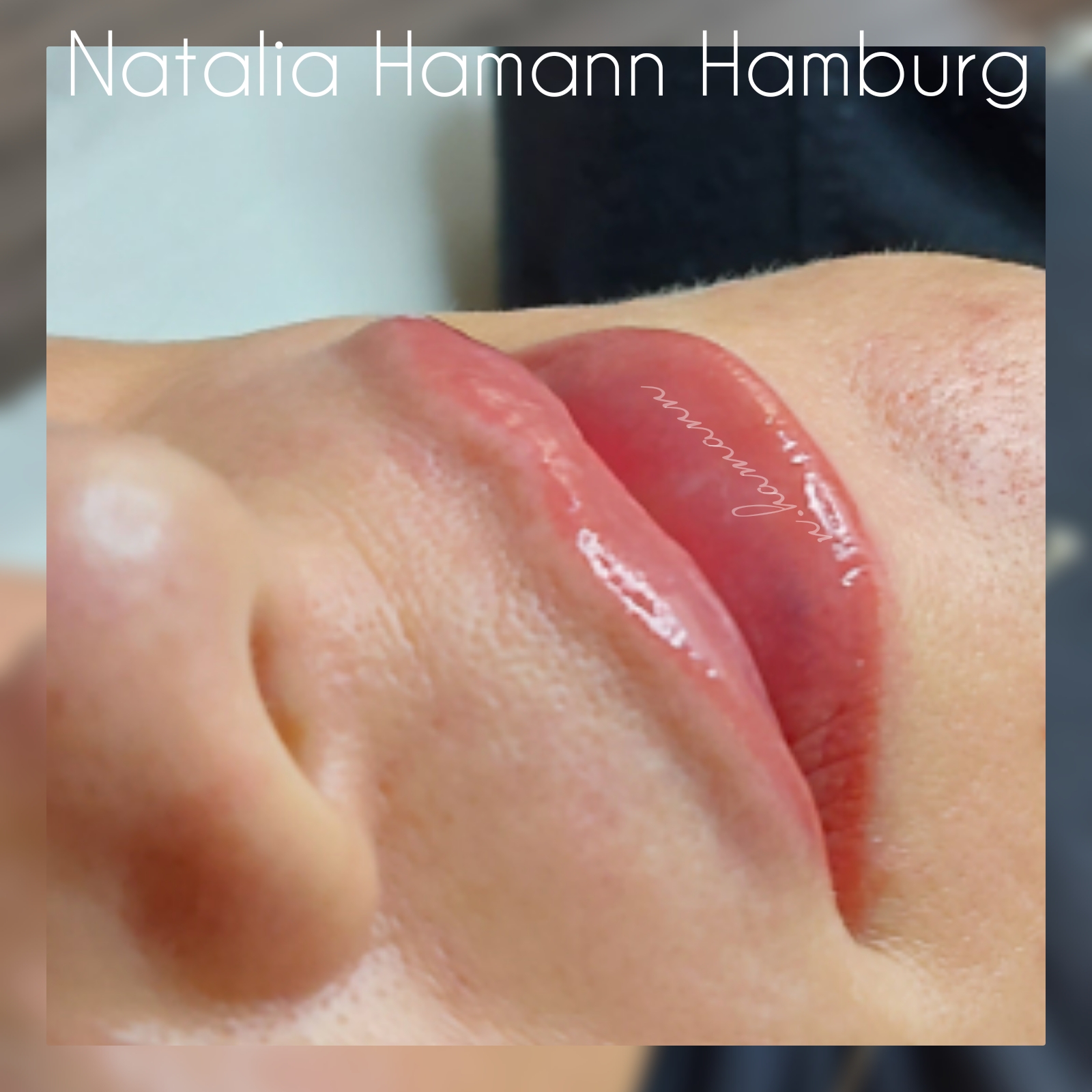 Russian Lips, Lippen aufspritzen Hamburg